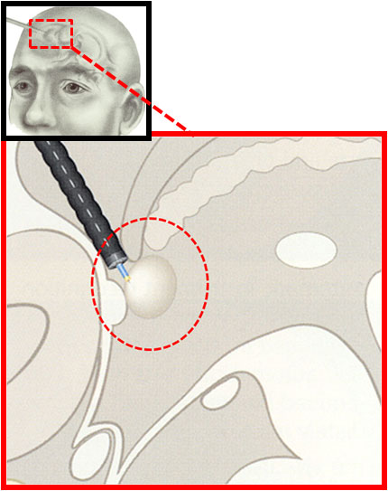 Endoscopische verwijdering van colloïden cyste van de derde ventrikel