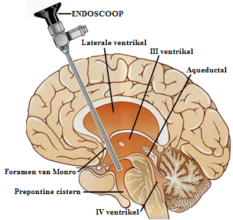 Overzicht endoscopische ventriculostomie van de derde ventrikel verdieping