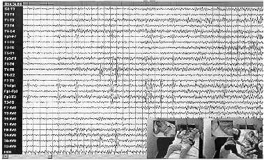 Video EEG image