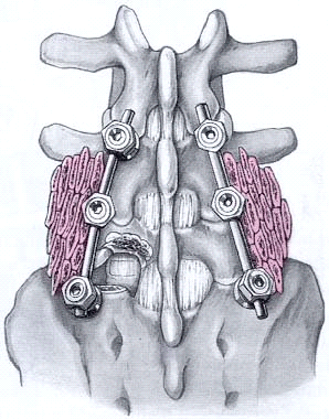Posterolaterale fusie met schroeven en staven in spondylolisthesis (roze bottransplantaat)