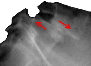 Lateral plain X-rays showing lumbar spondilolisthesis