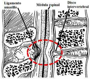 Estenosis del canal raquídeo cervical