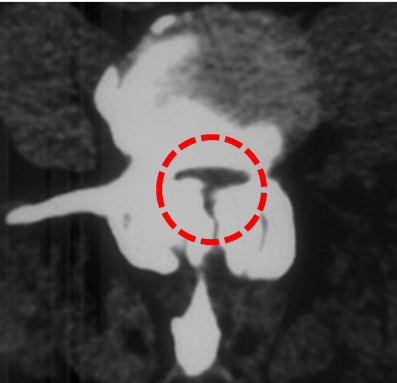 Imagen de TAC de estenosis de canal raquídeo a nivel lumbar 