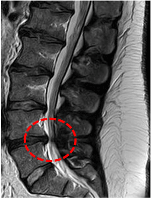 Imagen de RM de estenosis de canal raquídeo a nivel lumbar