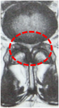 Imagen axial de estenosis de canal raquídeo a nivel lumbar 