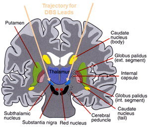 Anatomie der tiefsitzenden Nuklei der Parkinson-Krankheit in Verbindung