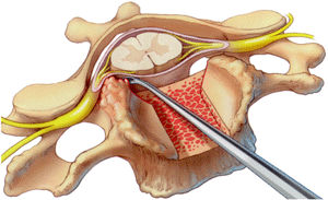 Extirpación de osteofitos que comprimen las raíces nerviosas en estenosis de canal raquídeo a nivel cervical 