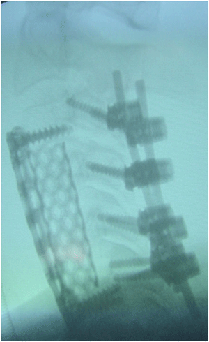 Imagen de Rx de artrodesis 360º para fractura de C4 y C5 