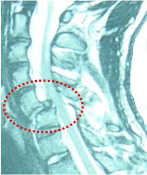 Imágen de RM de fractura-luxación de C5-C6 con lesión medular 