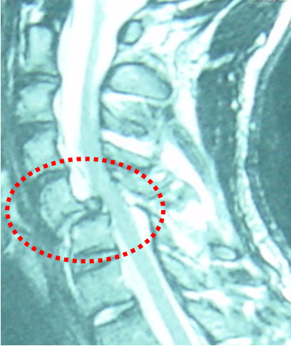 MR image of fracture-dislocation of C5-C6 with spinal cord injury