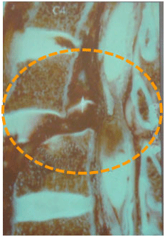 Fractuur-dislocatie van de C5-C6 met cervicale dwarslaesie