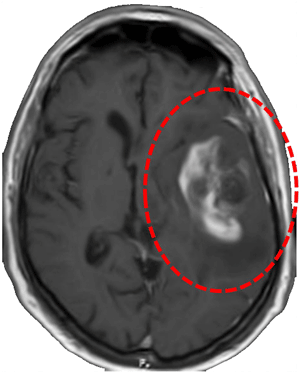 MRI image showing a glioblastoma multiforme