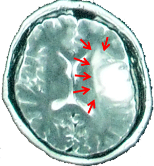 Brain oedema around a glioblastoma multiforme