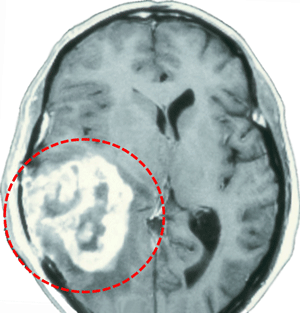 MR avbildning av glioblastoma multiforme
