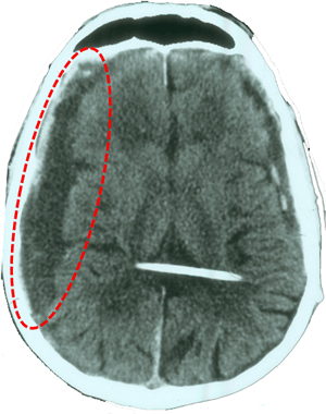 Subdural hematoma by excessive drainage in hydrocephalus