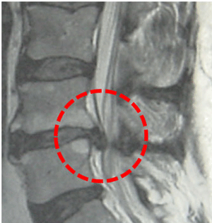 MR beeld van lumbale hernia
