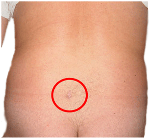 Scar after microdiscectomy to treat a herniated lumbar disc