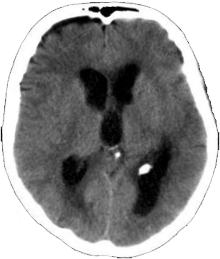 Imagen de TAC de hidrocefalia crónica del adulto 