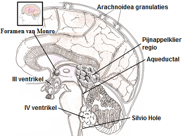 Punten van obstructie om de stroom van hersenvocht, waardoor hydrocephalus