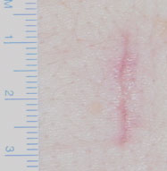 Cicatriz en estenosis canal lumbar
