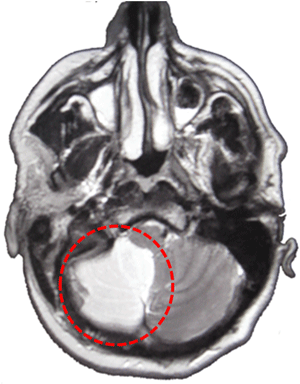 Imagen de RM en corte axial de infarto de cerebelo