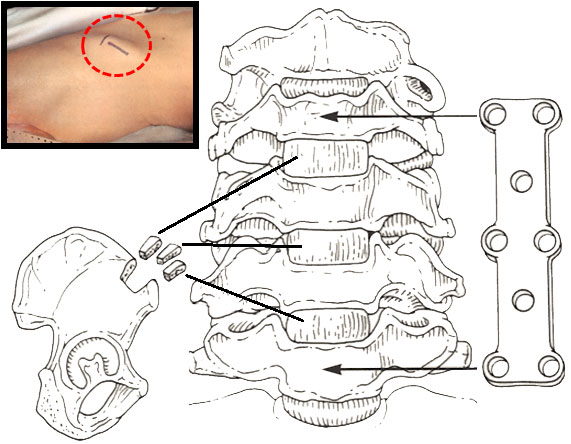 Bentransplantat från höftbenskammen med metallplatta vid dekompression av spinalstenos på nacknivå