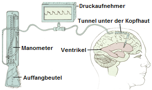 Druckmessung der Liquor durch einen externen ventrikulären drain