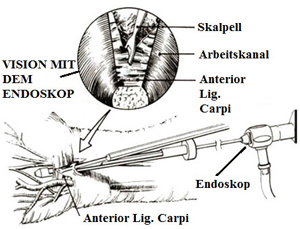 Endoskopische Ansatz zur Dekompression des Karpaltunnelsyndroms