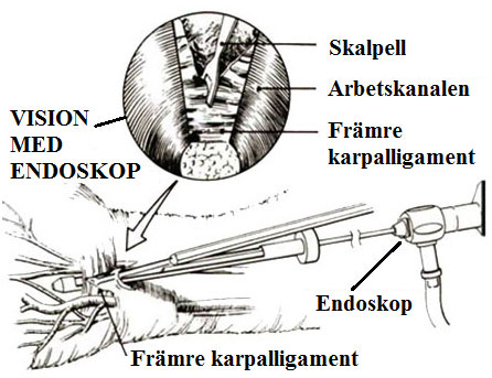 Endoskopisk strategi för dekompression av karpaltunnelsyndrom