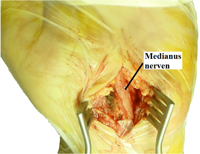 Kirurgisk bild efter fullständig del av främre karpalligament