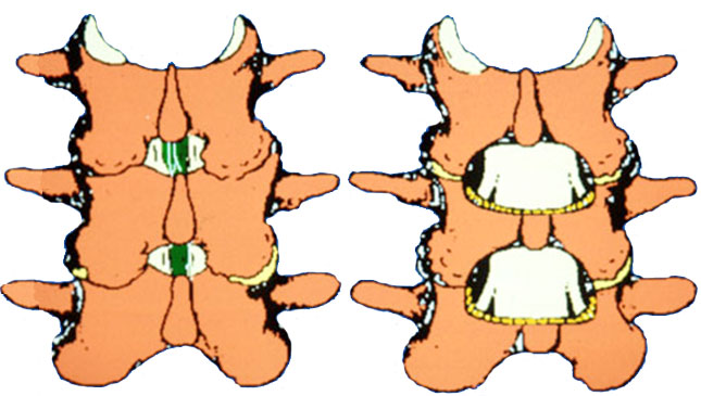 En regelbunden kolumn till vänster, höger, laminektomi