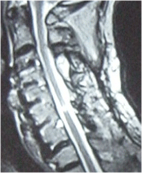 MR-bild av axiellt snitt av spinalstenos på nacknivå efter laminoplastik