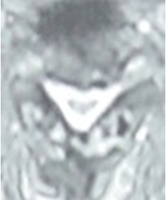 MR-bild i koronala delen av spinalstenos på nacknivå efter laminoplastik