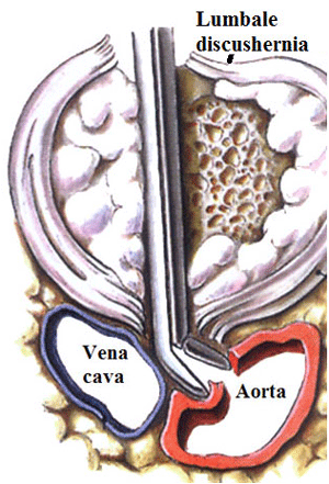 Letsel van de grote abdominale vaten tijdens lumbale discectomie