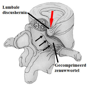 Zenuwwortel compressie door hernia lumbale