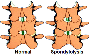 Lumbar Spondylolysis