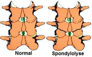Lumbale Spondylolyse