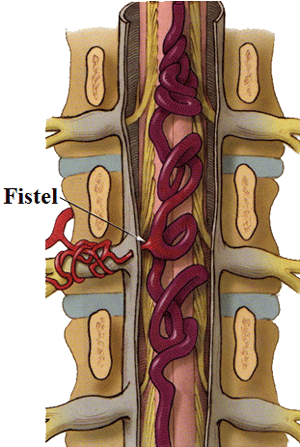 Spinal arteriovenöse Fehlbildungen Typ duralen