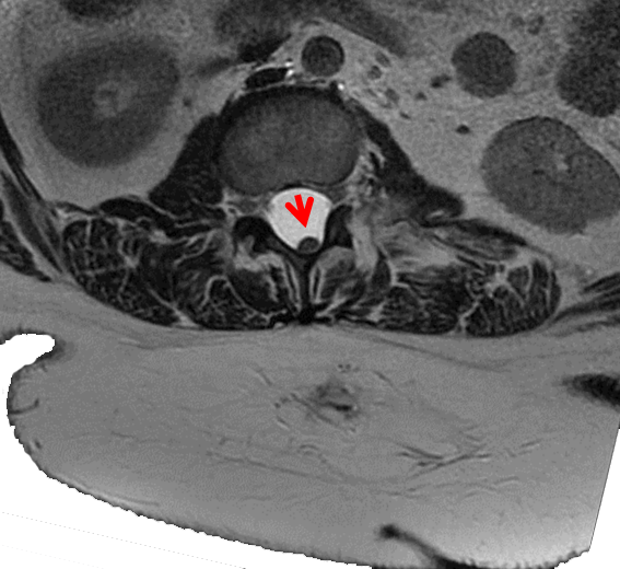 Imagen de RM en corte coronal de médula espinal anclada justo por encima de mielomeningocele no intervenido 