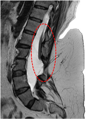 Imagen de RM en corte sagital de mielomeningocele no intervenido con médula espinal anclada 