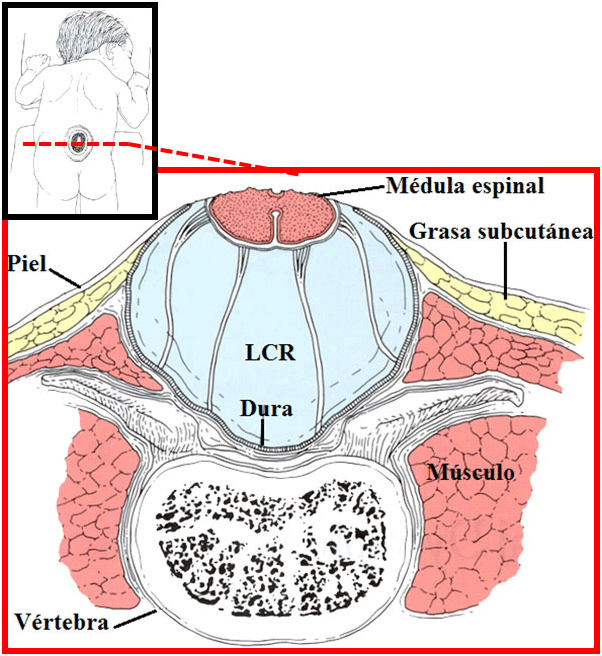 Corte axial en mielomeningocele 