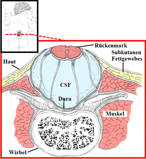 Axial Schnitt im Myelomeningozele