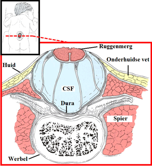 Axiale snede in myelomeningocele