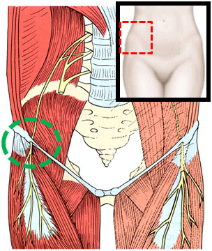 Entrapment of the lateral femoral cutaneous nerve (meralgia paresthetica)
