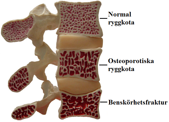 Utveckling av vertebrala osteoporos med åldern