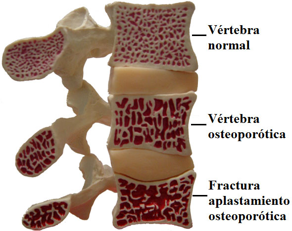 Evolución osteoporosis columna vertebral