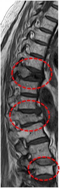 MRI-bild av flera benskörhetsfrakturer