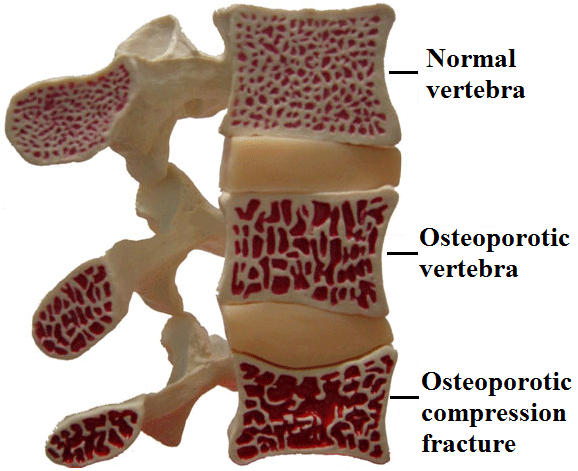 Stages of vertebral osteoporosis