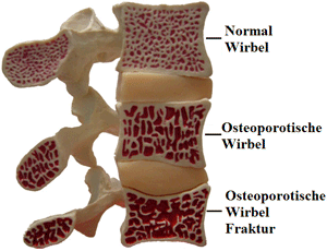 Evolution der Wirbelsäule Osteoporose mit dem Alter