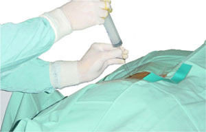 Ozone therapy to treat herniated lumbar disc